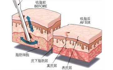 廣州哪家機(jī)構(gòu)吸脂減肥比較好