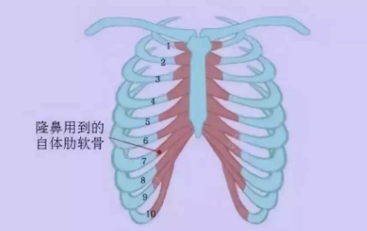 自體軟骨隆鼻的好處有哪些呢