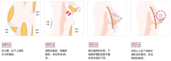 廣州做自體脂肪隆胸術后會不會出現胸部下垂的現象呢