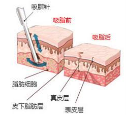 抽脂減肥會(huì)不會(huì)有后遺癥