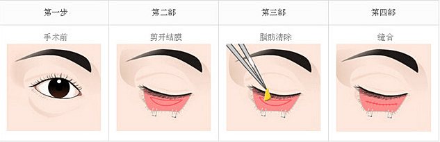 去眼袋的方法