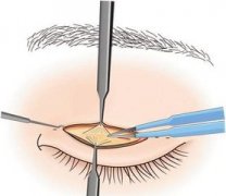 廣州上瞼下垂矯正需要多少錢(qián)呢