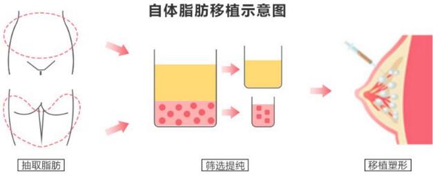 自體脂肪豐胸多久可以穩定下來