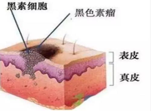 激光祛斑價格