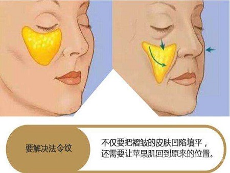 脂肪填充法令紋能維持多少時間？