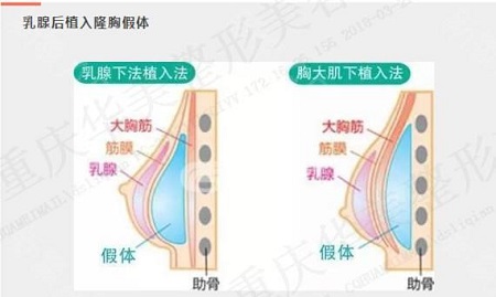 假體豐胸失敗修復(fù)價格