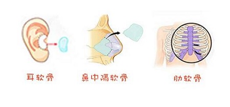 自體軟骨隆鼻的潛在風險