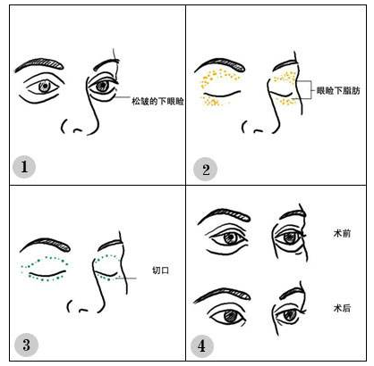 北京做眼部吸脂手術哪家醫(yī)院好