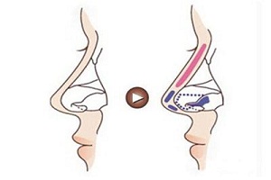 自體軟骨組織隆鼻