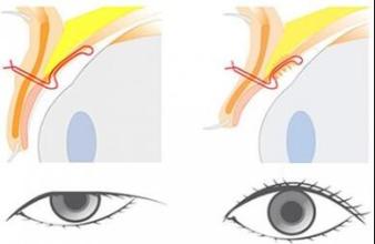 上瞼下垂矯正手術(shù)
