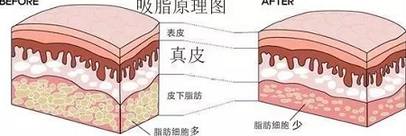 腿部吸脂減肥