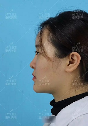 “鼻綜合”后假又歪，還攣縮？鼻修復還原自然生態美鼻