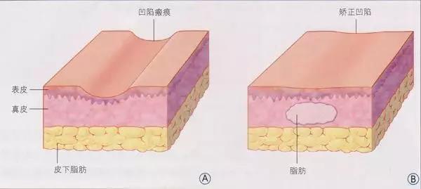 自體脂肪填充為什么需要二次補打？