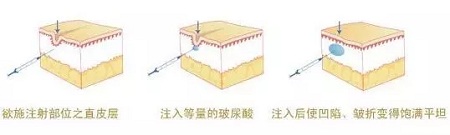 法令紋、川字紋