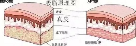 醫(yī)美白皮書(shū)：吸脂等于減肥嗎？