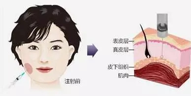 瘦臉會(huì)導(dǎo)致臉部凹陷松弛？