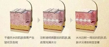 水光，打1次和4次究竟有多大區(qū)別？