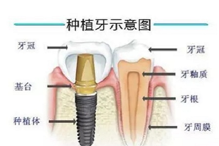 揭秘牙齒矯正的全過程！！！