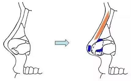耳軟骨隆鼻過程圖