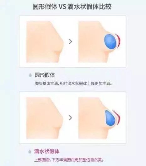 [我問大醫師]隆乳手術問題，你想要的答案，這里都有