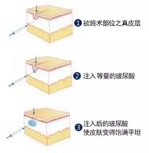 用玻尿酸治療鼻唇溝，一定要注意這種情況！