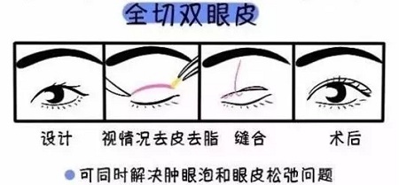 美眼張誠(chéng)坐診美萊，淺談為什么你的眼睛不夠美？