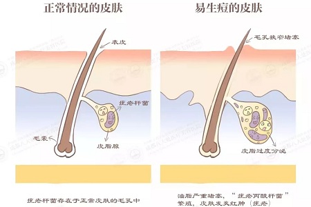 正常情況的毛孔VS易生痘的毛孔