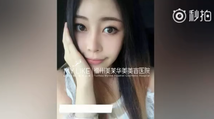 福州美萊鼻子幾毫米的改變，自信百倍的蛻變