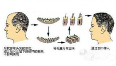 鄭州美萊整形醫院植發做的好嗎