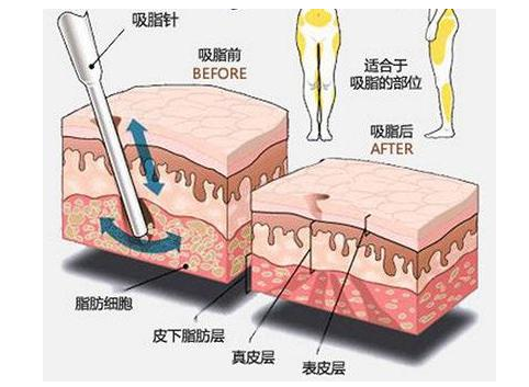 鄭州美萊吸脂瘦身等于減重？