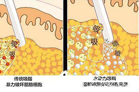 腹部吸脂減肥會反彈嗎