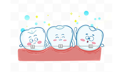 自鎖托槽牙齒矯正價格