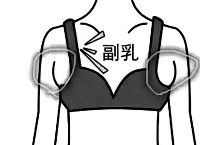 副乳切除術后需要住院嗎