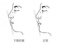 怎樣判斷下巴是否短縮，重慶整形醫院做矯正手術多少錢