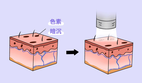 想要嫩膚，應(yīng)該選擇做光電還是水光